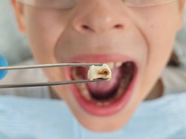 Best Knocked-Out Tooth (Avulsed Tooth) Treatment in Blauvelt, NY